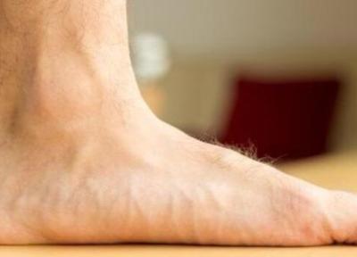 یک متخصص برجسته ارتوپدی و جراح کف پا: جراحی، درمان قطعی و نهایی کف پای صاف است