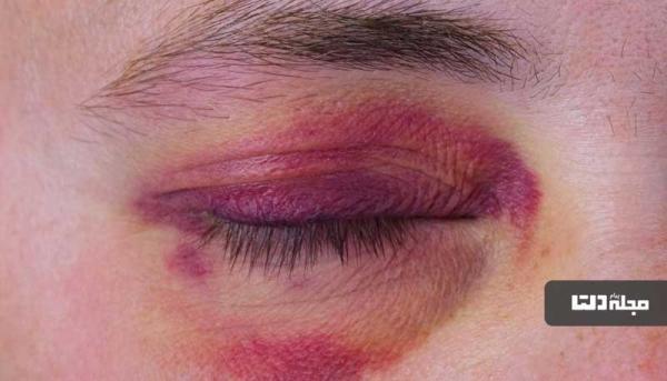 کبودی چشم را با 5 روش از بین ببرید!